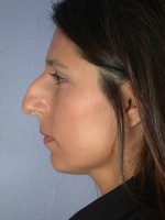 Nose Reshaping Before and after photo