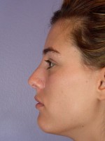 Nose Reshaping Before and after photo