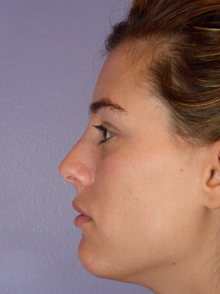 Nose Reshaping before and after photo