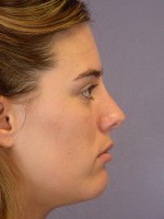 Nose Reshaping Before and after photo