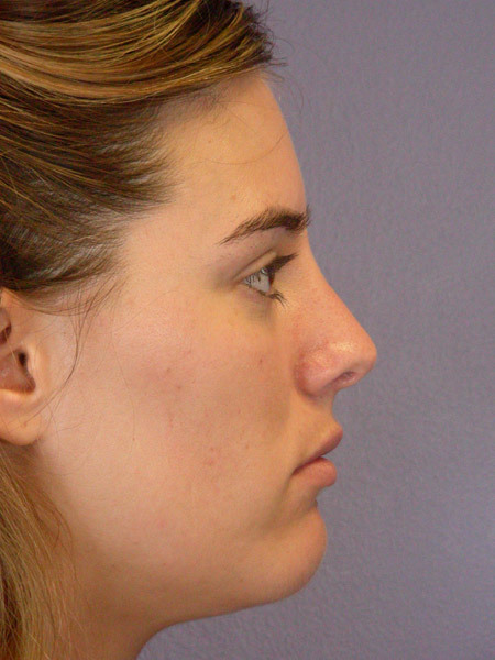 Nose Reshaping before and after photo