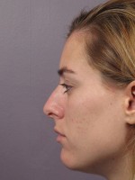 Nose Reshaping Before and after photo