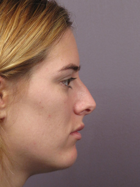 Nose Reshaping before and after photo