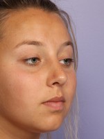 Nose Reshaping Before and after photo