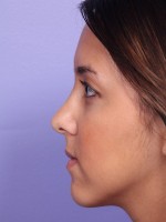 Nose Reshaping Before and after photo