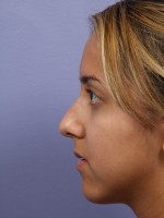 Nose Reshaping Before and after photo