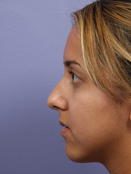 Nose Reshaping before and after photo