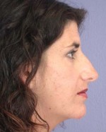 Nose Reshaping Before and after photo