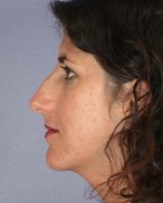 Nose Reshaping Before and after photo