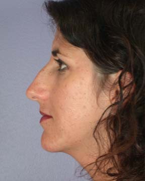 Nose Reshaping before and after photo