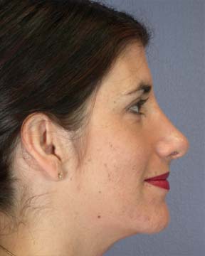 Nose Reshaping before and after photo