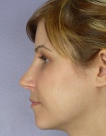 Nose Reshaping Before and after photo