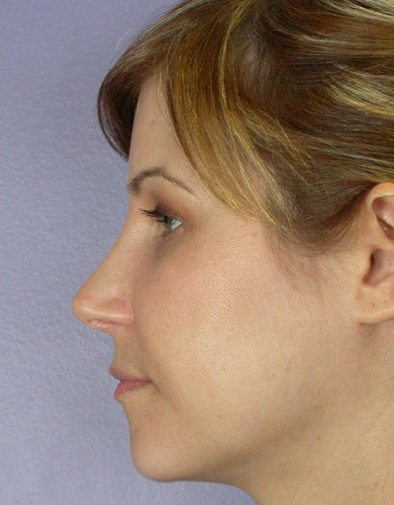 Nose Reshaping before and after photo