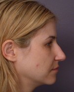 Nose Reshaping Before and after photo