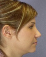 Nose Reshaping Before and after photo