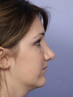 Nose Reshaping Before and after photo