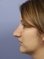 Nose Reshaping Before and after photo