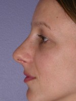 Nose Reshaping Before and after photo