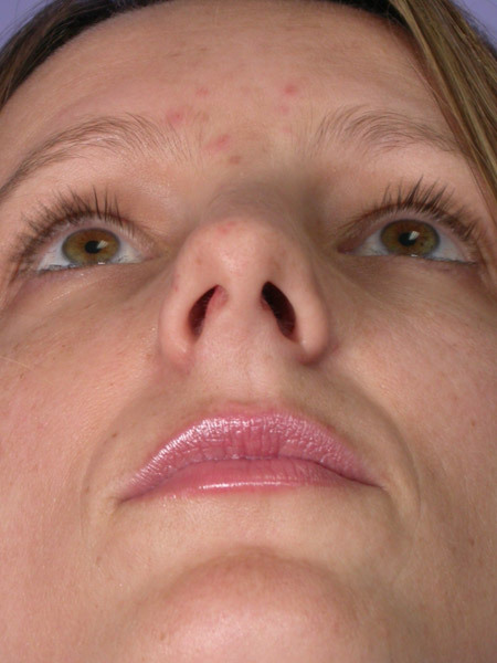 Nose Reshaping before and after photo