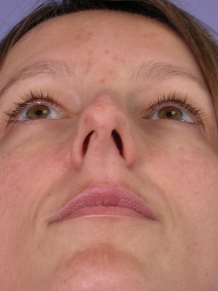 Nose Reshaping before and after photo