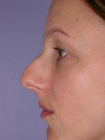 Nose Reshaping