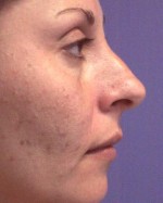 Nose Reshaping