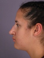 Nose Reshaping Before and after photo