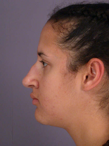 Nose Reshaping before and after photo