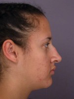 Nose Reshaping Before and after photo