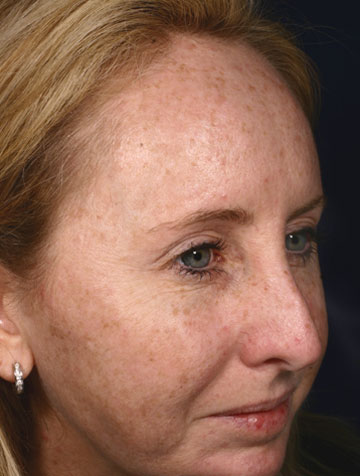 Fraxel® before and after photo