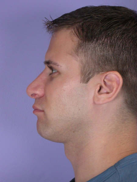 Nose Reshaping before and after photo