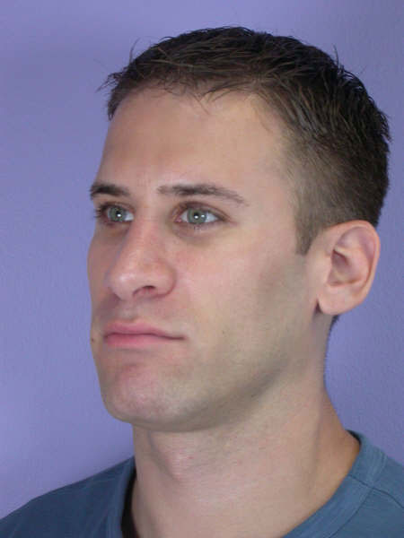 Nose Reshaping before and after photo