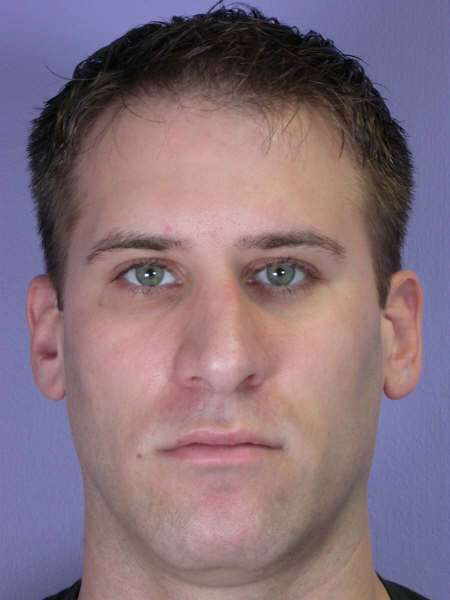 Nose Reshaping before and after photo