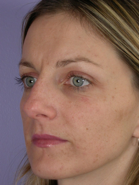 Nose Reshaping before and after photo