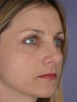 Nose Reshaping