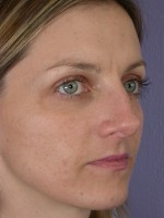 Nose Reshaping Before and after photo