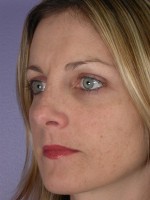 Nose Reshaping Before and after photo