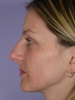 Nose Reshaping Before and after photo