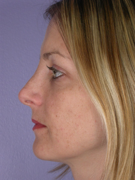 Nose Reshaping before and after photo