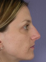 Nose Reshaping Before and after photo