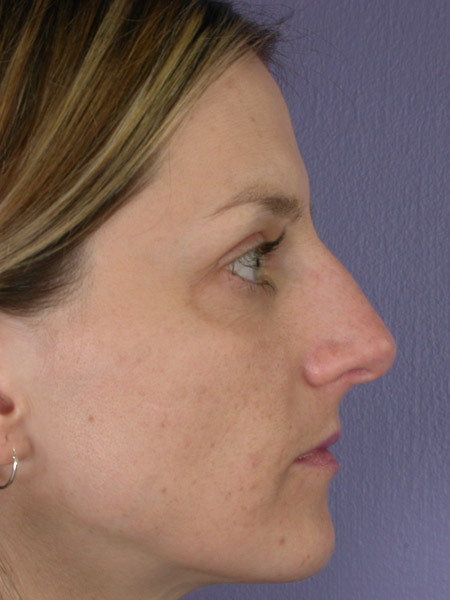 Nose Reshaping before and after photo