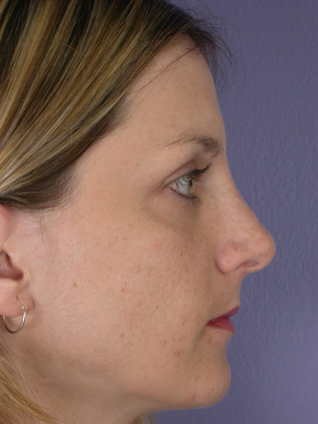 Nose Reshaping before and after photo