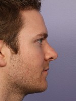 Nose Reshaping Before and after photo