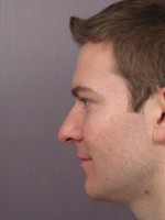 Nose Reshaping Before and after photo