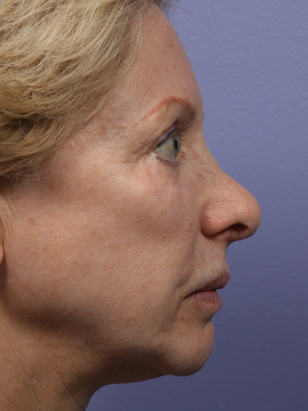 Nose Reshaping before and after photo