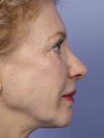 Nose Reshaping Before and after photo