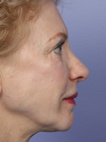 Nose Reshaping before and after photo