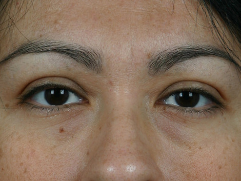 Injectable Fillers before and after photo