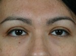 Injectable Fillers Before and after photo