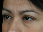 Injectable Fillers Before and after photo